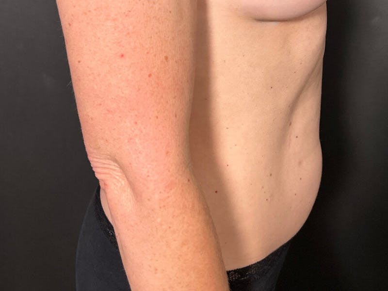 Abdomen Before & After Gallery - Patient 151954 - Image 5