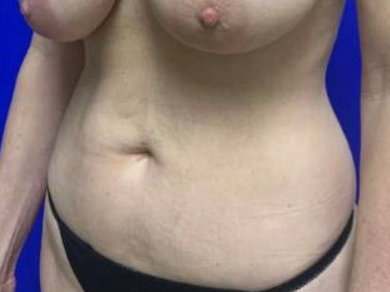 Mini Tummy Tuck Before & After Gallery - Patient 491163 - Image 8