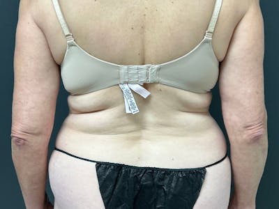 Back Before & After Gallery - Patient 277717 - Image 1