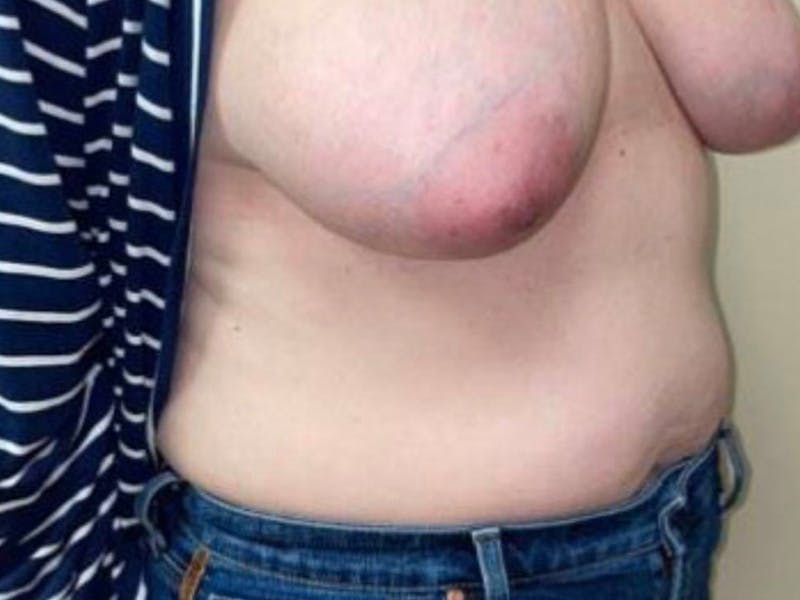 Abdomen Before & After Gallery - Patient 332408 - Image 3