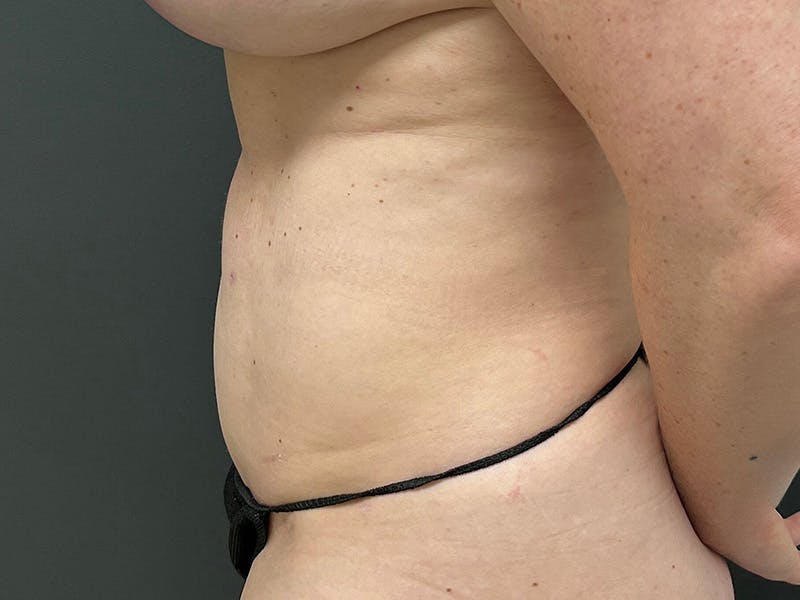 Abdomen Before & After Gallery - Patient 419008 - Image 10