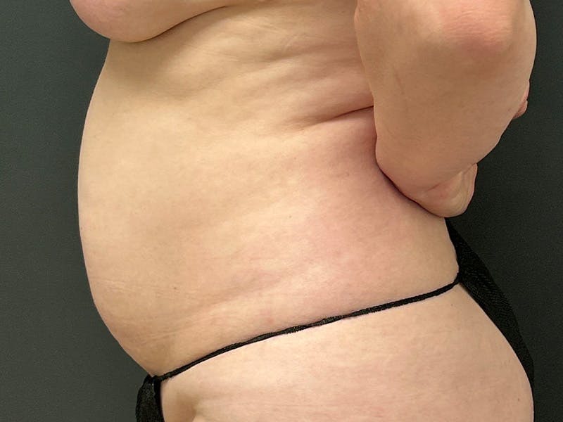 Abdomen Before & After Gallery - Patient 272999 - Image 5