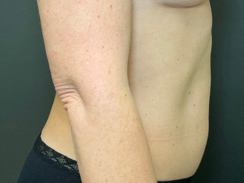 Mini Tummy Tuck Before & After Gallery - Patient 418282 - Image 6