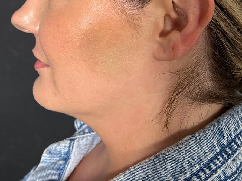 Submental Before & After Gallery - Patient 252708 - Image 9