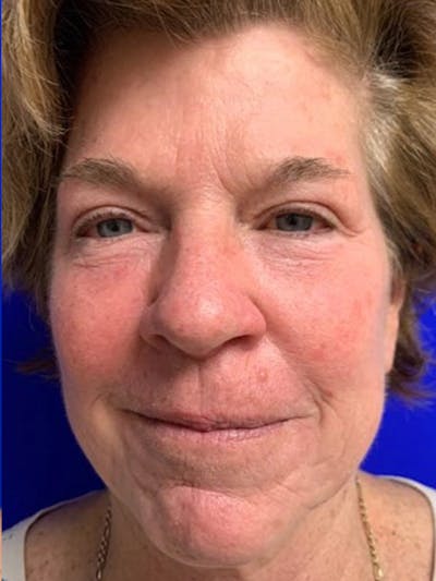 Brow Lift Before & After Gallery - Patient 256609 - Image 2