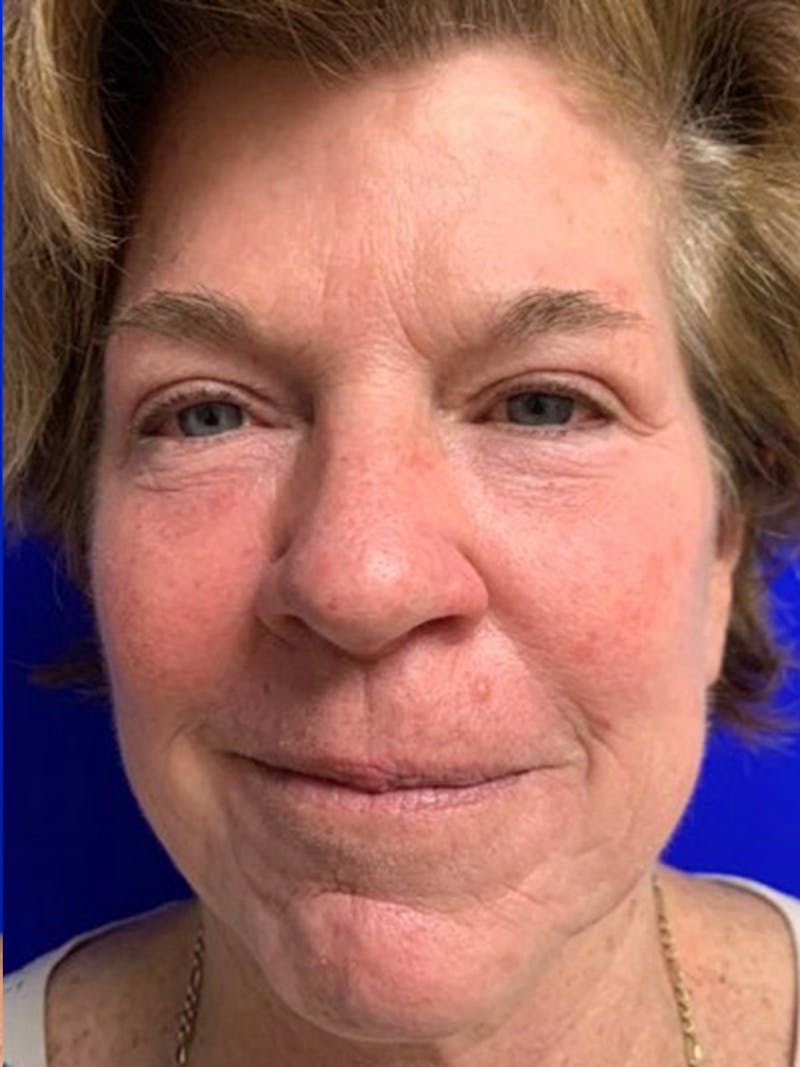 Brow Lift Before & After Gallery - Patient 256609 - Image 2