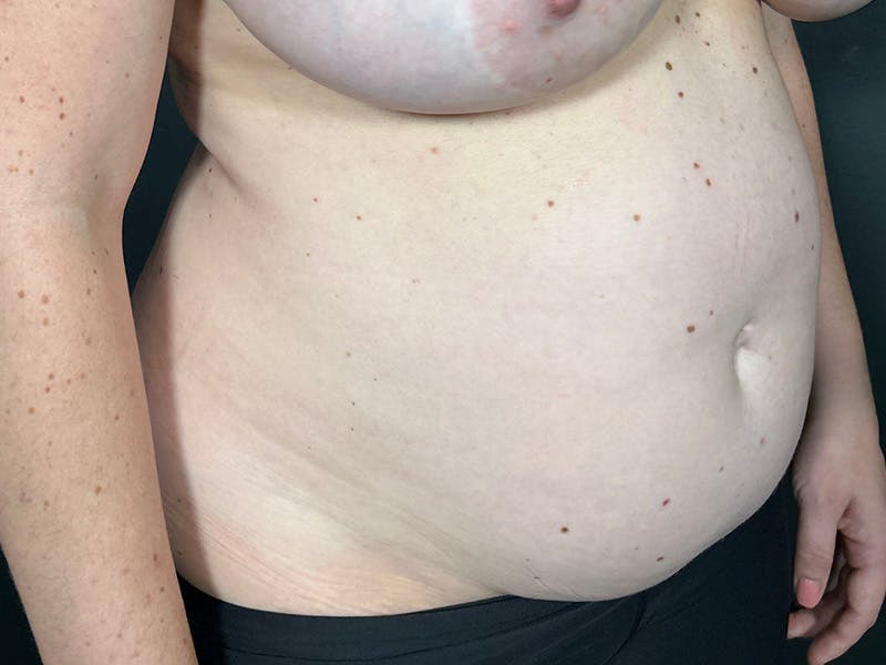 Mini Tummy Tuck Before & After Gallery - Patient 169656 - Image 3
