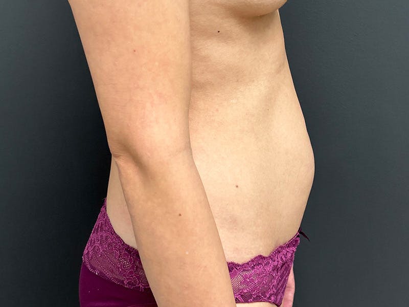 Abdomen Before & After Gallery - Patient 171479 - Image 5