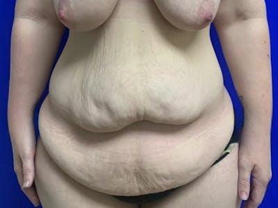 Tummy Tuck Before & After Gallery - Patient 115727 - Image 1
