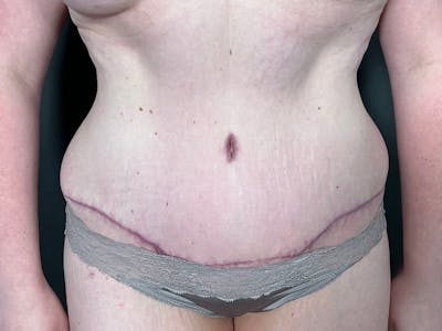 Tummy Tuck Before & After Gallery - Patient 404858 - Image 2