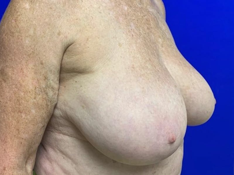 Breast Reconstruction Before & After Gallery - Patient 265807 - Image 3