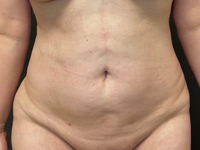 Abdomen Before & After Gallery - Patient 272999 - Image 2