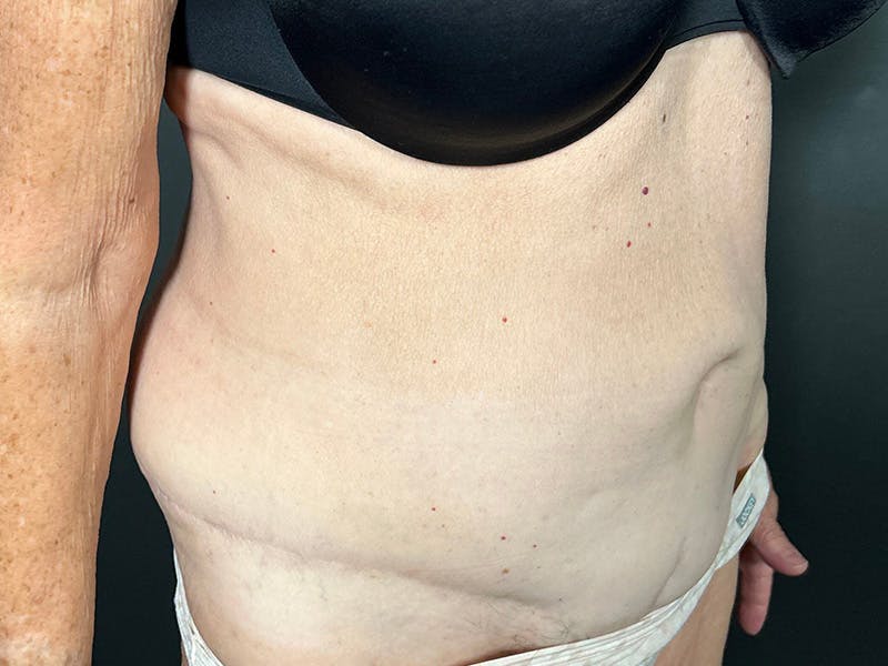 Tummy Tuck Before & After Gallery - Patient 394420 - Image 3