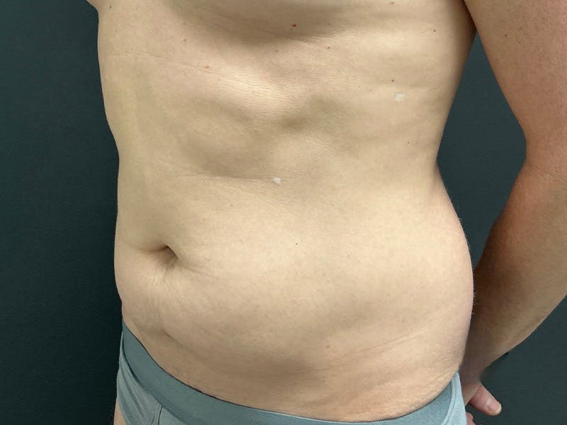 Abdomen Before & After Gallery - Patient 406127 - Image 7