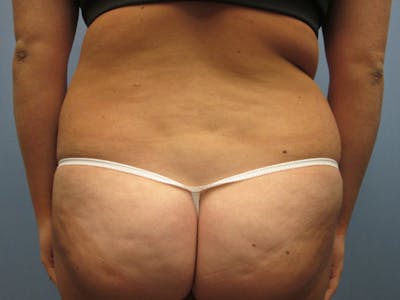 Back Before & After Gallery - Patient 907716 - Image 1