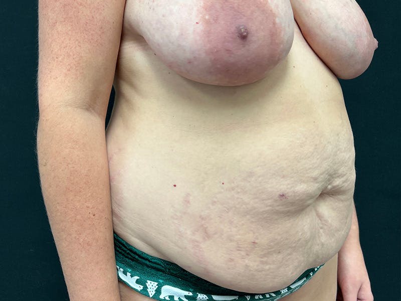 Tummy Tuck Before & After Gallery - Patient 187996 - Image 3