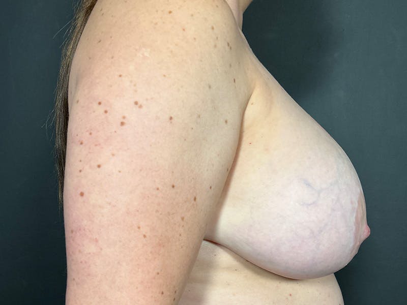 Breast Fat Grafting Before & After Gallery - Patient 125861 - Image 5