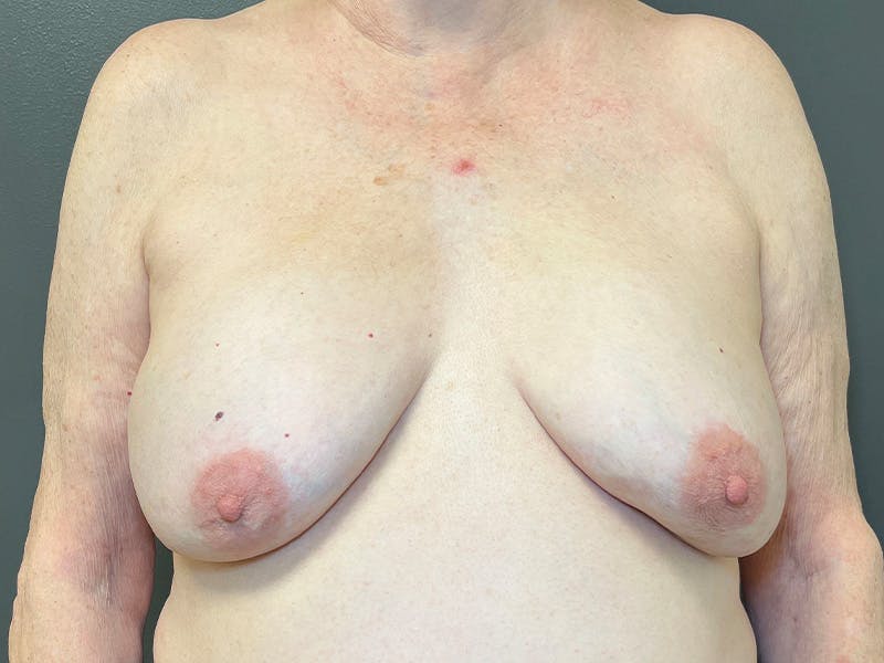 Breast Reconstruction Before & After Gallery - Patient 165209 - Image 1