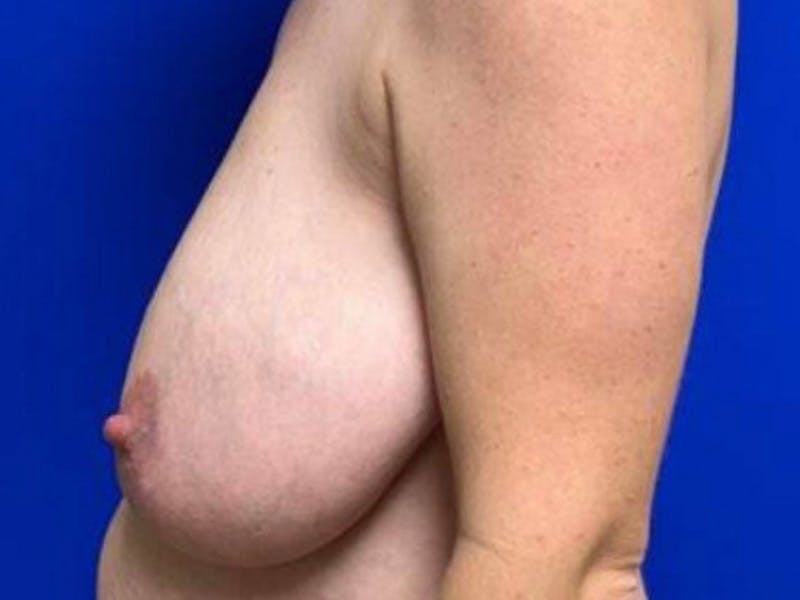 Breast Reduction Before & After Gallery - Patient 101592 - Image 5