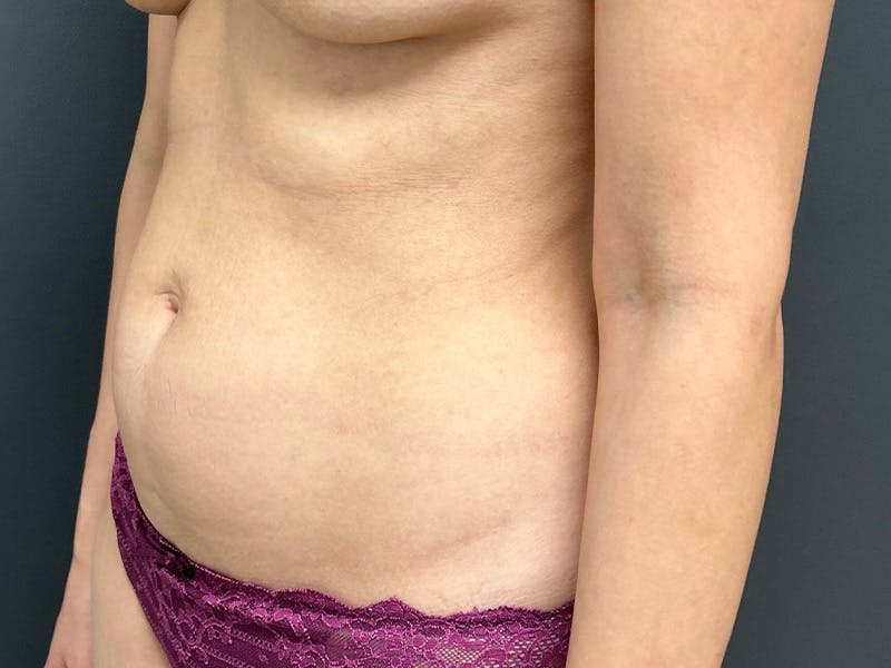 Abdomen Before & After Gallery - Patient 171479 - Image 7
