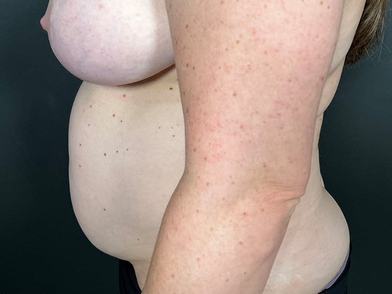 Mini Tummy Tuck Before & After Gallery - Patient 169656 - Image 9