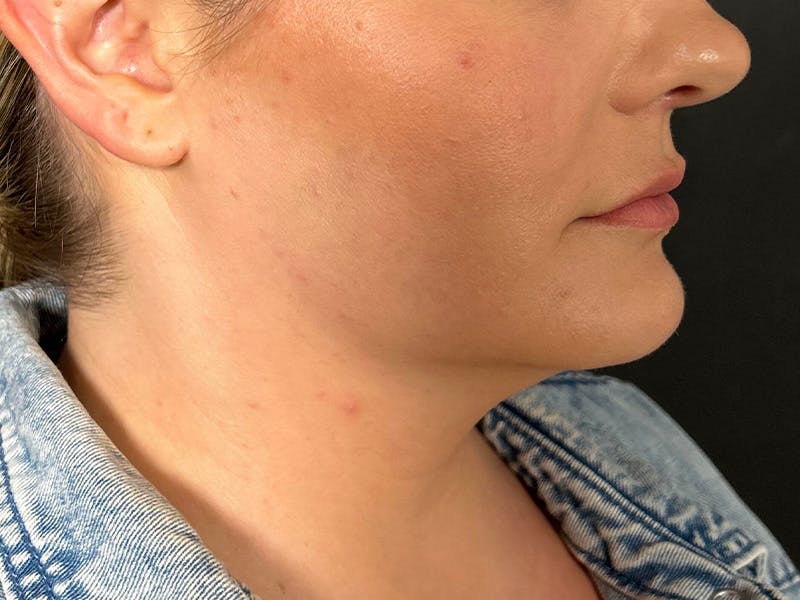 Submental Before & After Gallery - Patient 252708 - Image 3