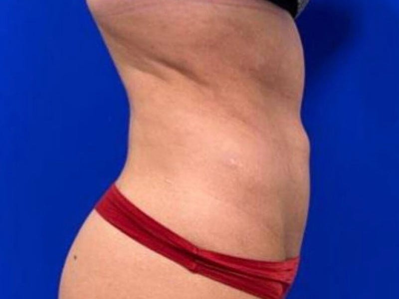 Tummy Tuck Before & After Gallery - Patient 266737 - Image 6
