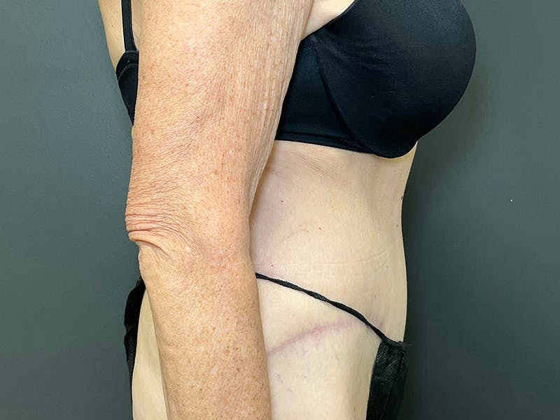 Tummy Tuck Before & After Gallery - Patient 394420 - Image 6