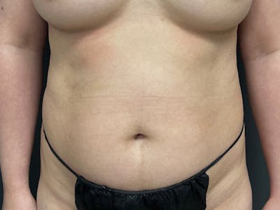 Abdomen Before & After Gallery - Patient 153440 - Image 1