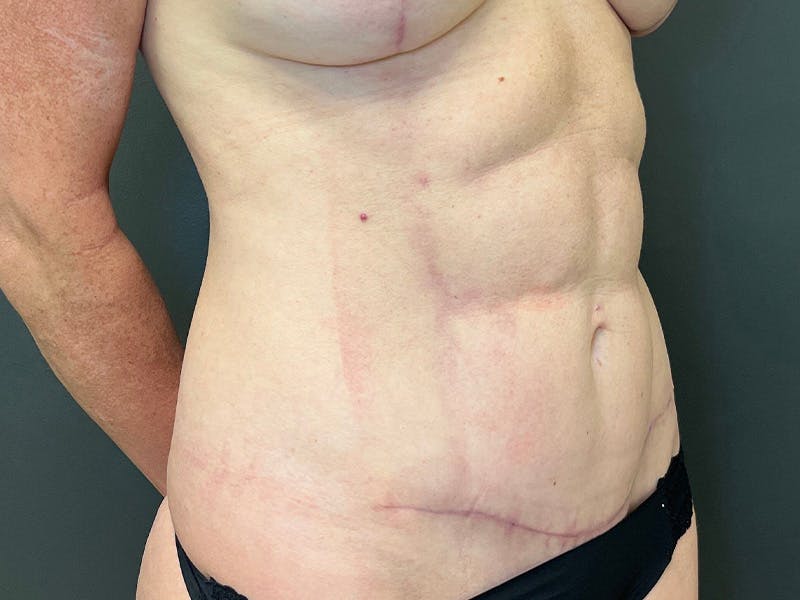 Abdomen Before & After Gallery - Patient 357328 - Image 4
