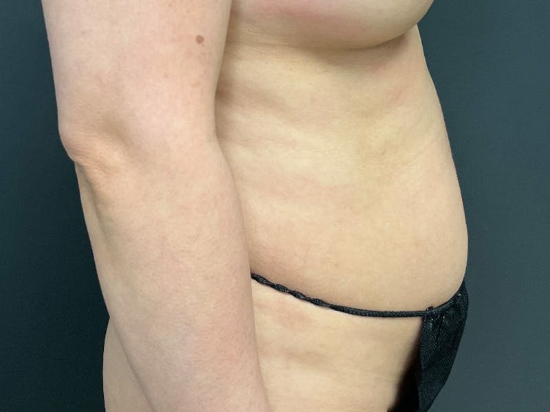 Tummy Tuck Before & After Gallery - Patient 223386 - Image 3