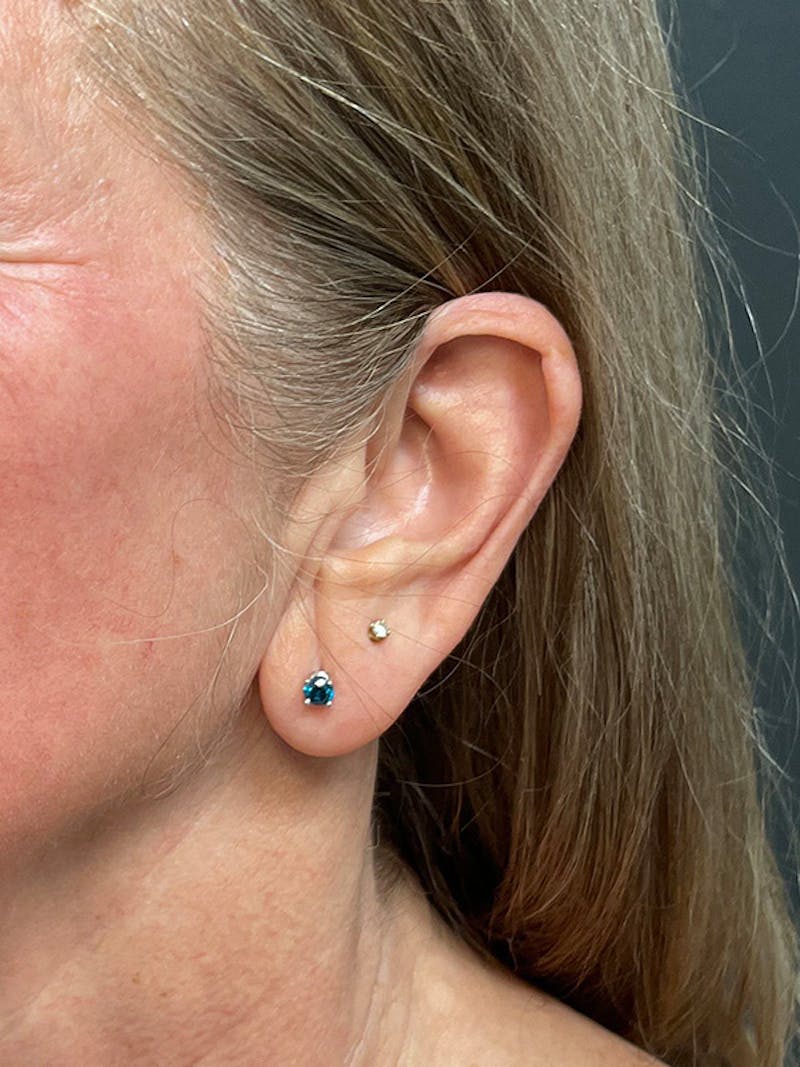 Earlobe Repair Before & After Gallery - Patient 298992 - Image 7