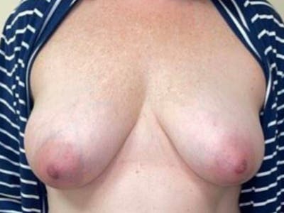 Breast Implant Reconstruction Before & After Gallery - Patient 121284 - Image 1