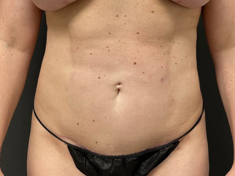 Abdomen Before & After Gallery - Patient 419008 - Image 2