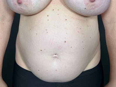 Mini Tummy Tuck Before & After Gallery - Patient 169656 - Image 1