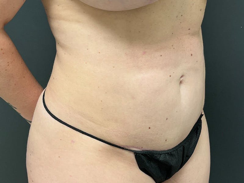 Abdomen Before & After Gallery - Patient 419008 - Image 4