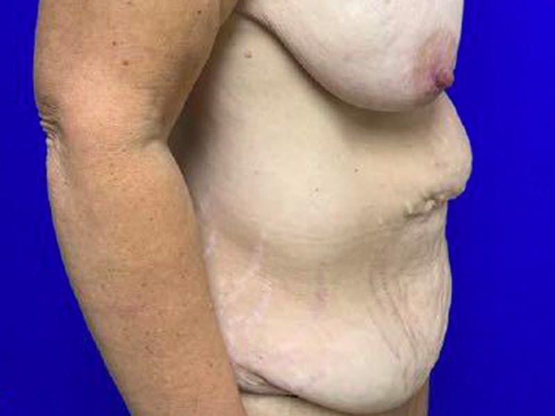 Tummy Tuck Before & After Gallery - Patient 165824 - Image 5