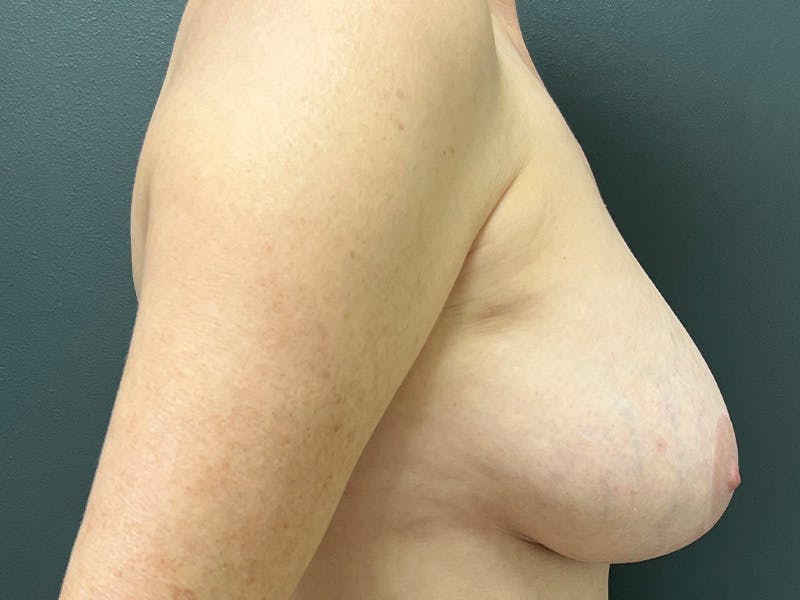 Mastopexy (Breast Lift) Before & After Gallery - Patient 402414 - Image 6