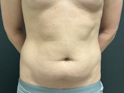 Abdomen Before & After Gallery - Patient 406127 - Image 1