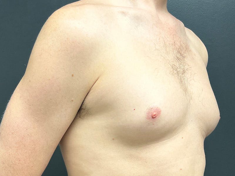 Gynecomastia Before & After Gallery - Patient 376405 - Image 3