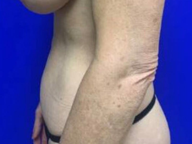 Mini Tummy Tuck Before & After Gallery - Patient 491163 - Image 10