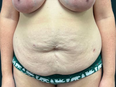Tummy Tuck Before & After Gallery - Patient 187996 - Image 1