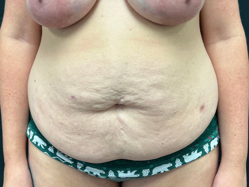 Tummy Tuck Before & After Gallery - Patient 187996 - Image 1