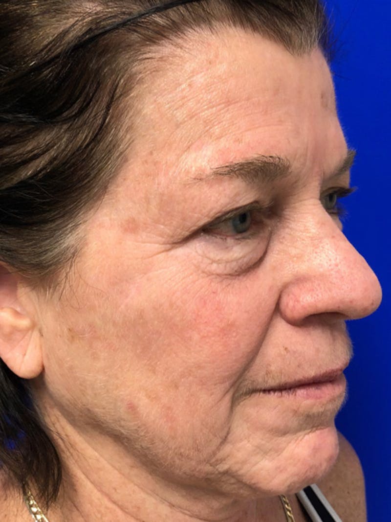 Brow Lift Before & After Gallery - Patient 256609 - Image 3