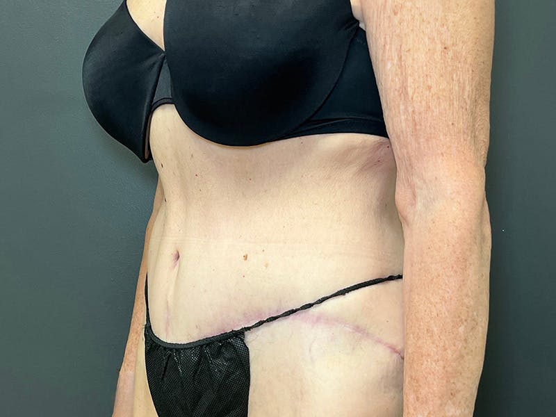Tummy Tuck Before & After Gallery - Patient 394420 - Image 8