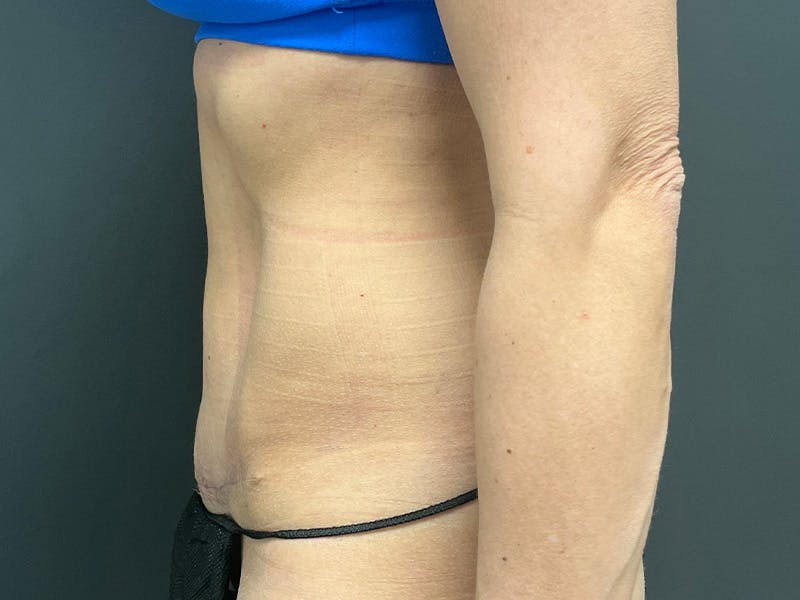Mini Tummy Tuck Before & After Gallery - Patient 120272 - Image 10