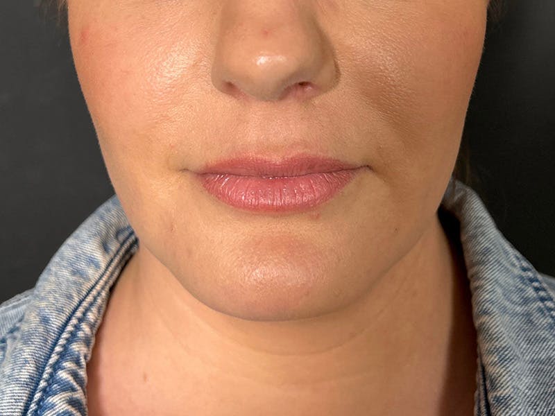 Submental Before & After Gallery - Patient 252708 - Image 5