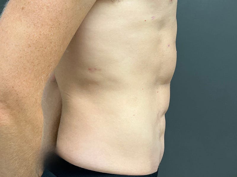 Abdomen Before & After Gallery - Patient 406127 - Image 6