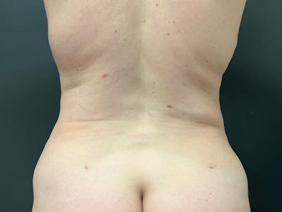 Back Before & After Gallery - Patient 302715 - Image 2