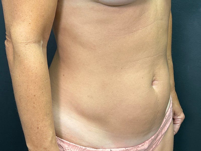 Mini Tummy Tuck Before & After Gallery - Patient 246074 - Image 3